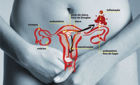 Endometriose e menstruação